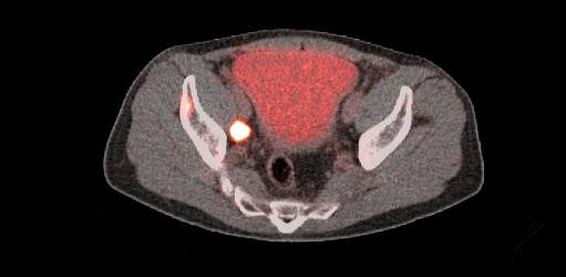 POSLUMA PET scan showing uptake in the perirectal lymph node