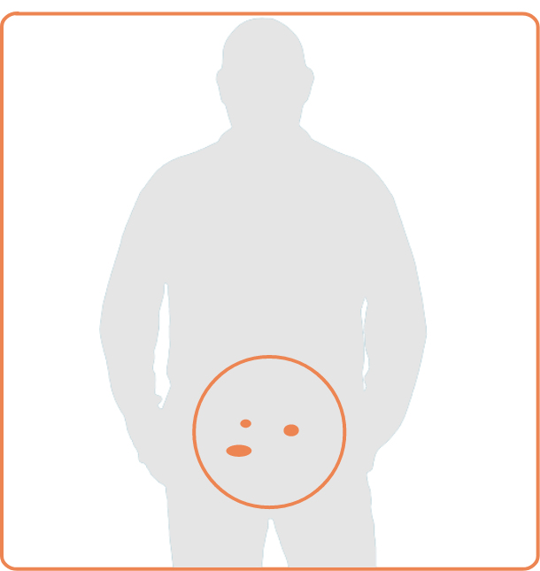 Silouette of a man with orange ovals representing prostate cancer identified through an imaging scan