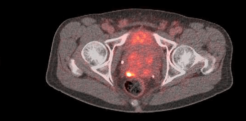 POSLUMA PET scan showing uptake in the internal iliac lymph node