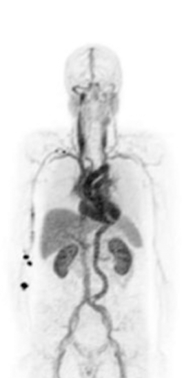 PET image of healthy volunteer 1 minute after administration of POSLUMA